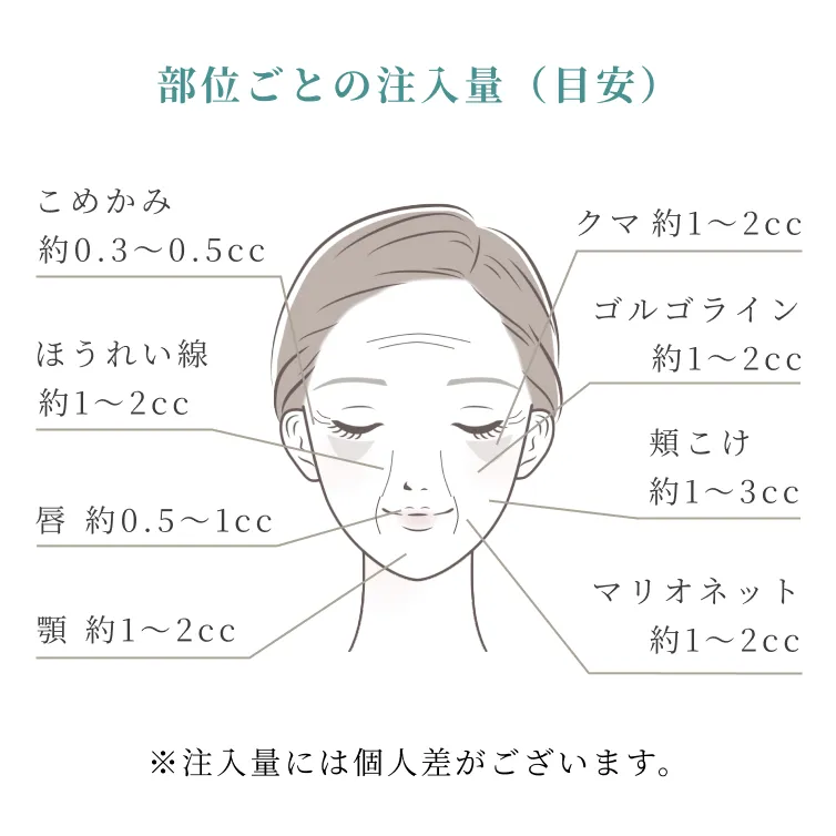 浅いシワの場合はヒアルロン酸を1本注入。深いシワの場合は2本注入。