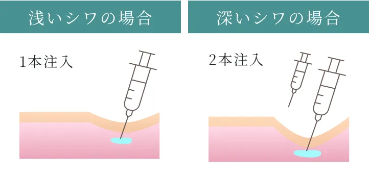 浅いシワの場合はヒアルロン酸を1本注入。深いシワの場合は2本注入。